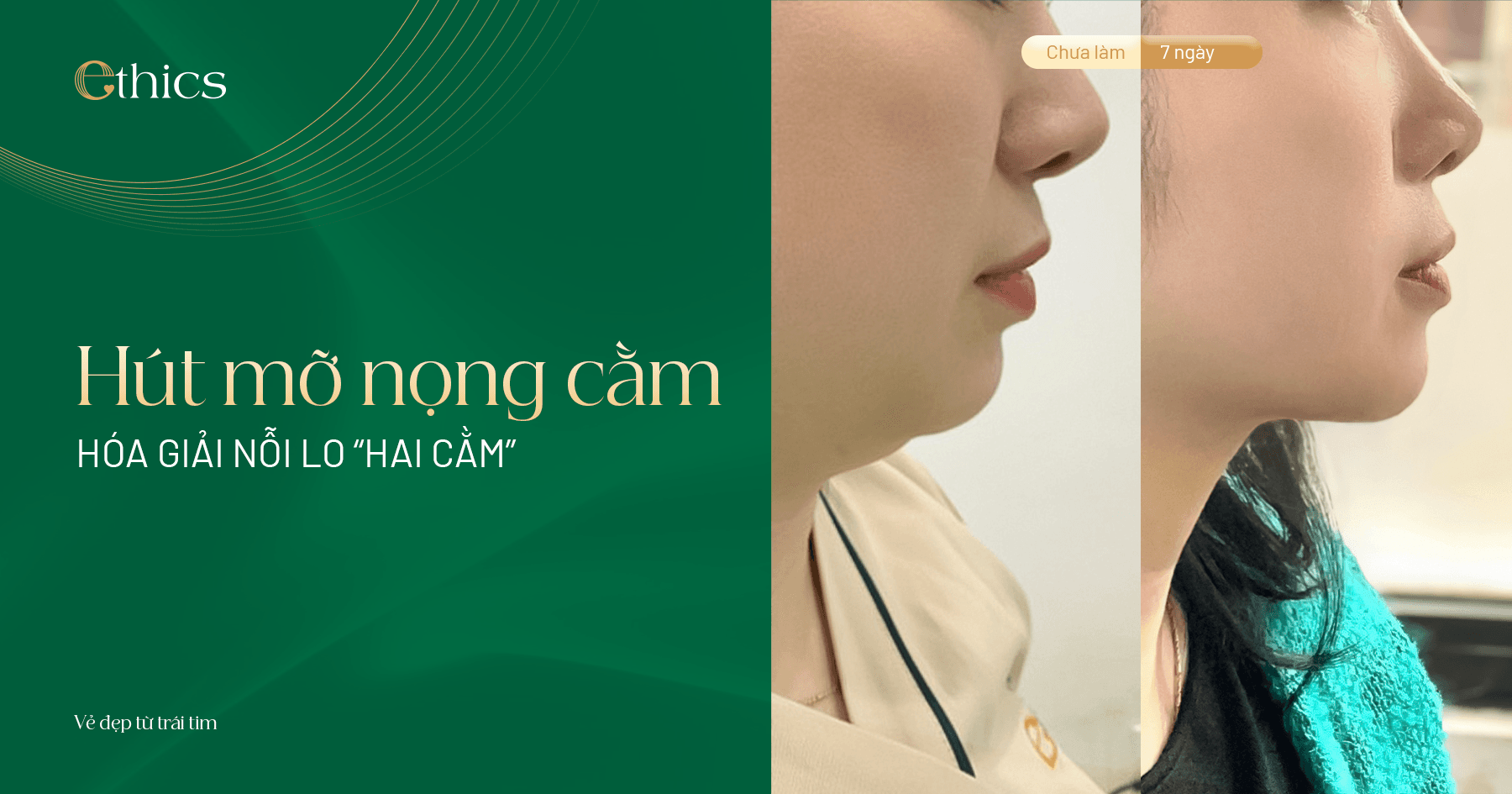 Chin reduction surgery