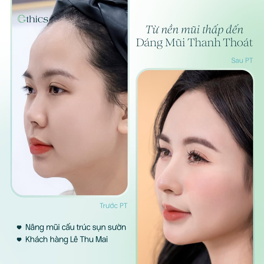 Image of the rib cartilage structural rhinoplasty case of Le Thu Mai published by Ethics on 20/09/2026