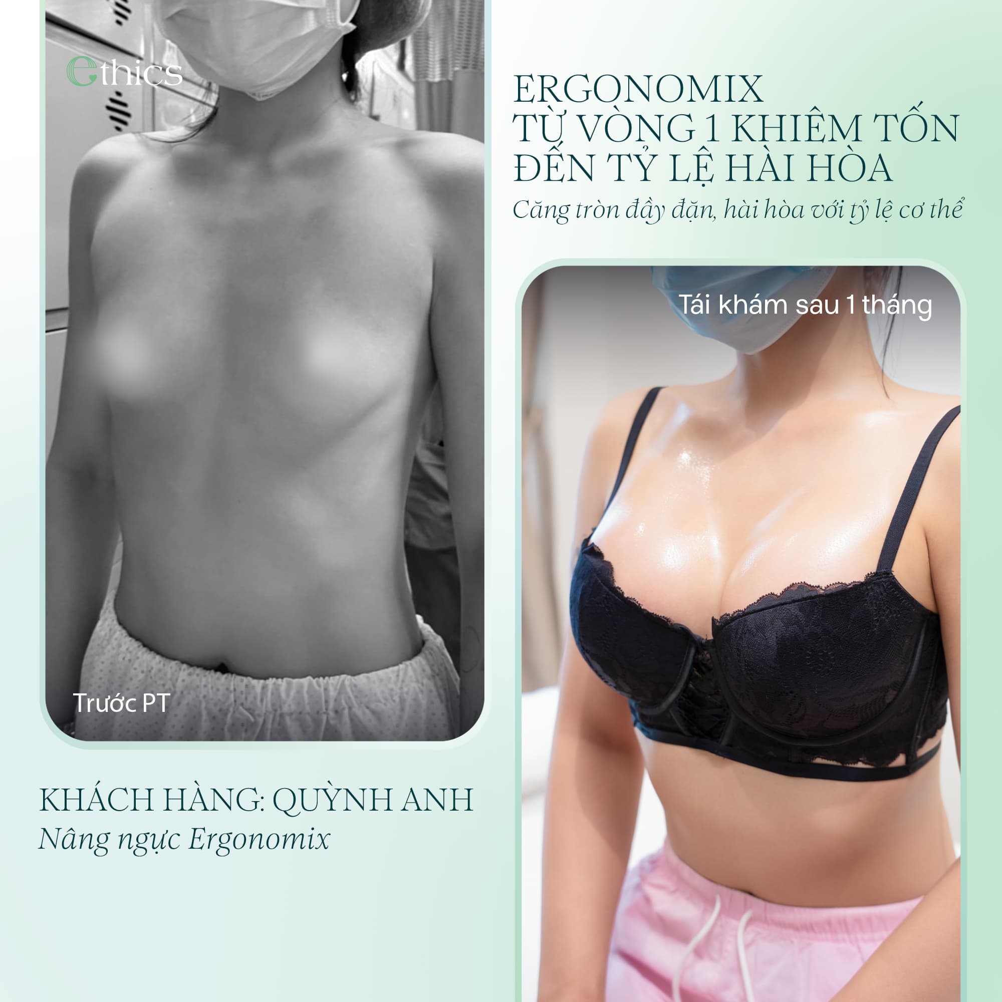 Breast augmentation