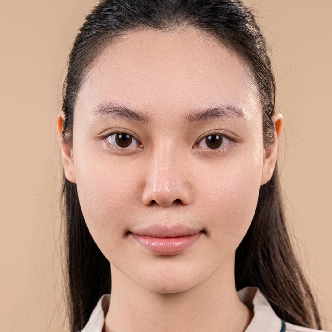 Patient Luu Phuong Anh - Before the One fit rhinoplasty procedure