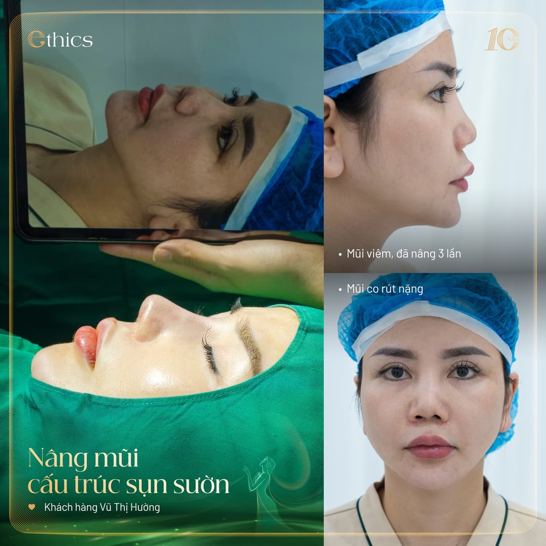 Autologous rib cartilage structural rhinoplasty at Ethics Aesthetic Institute