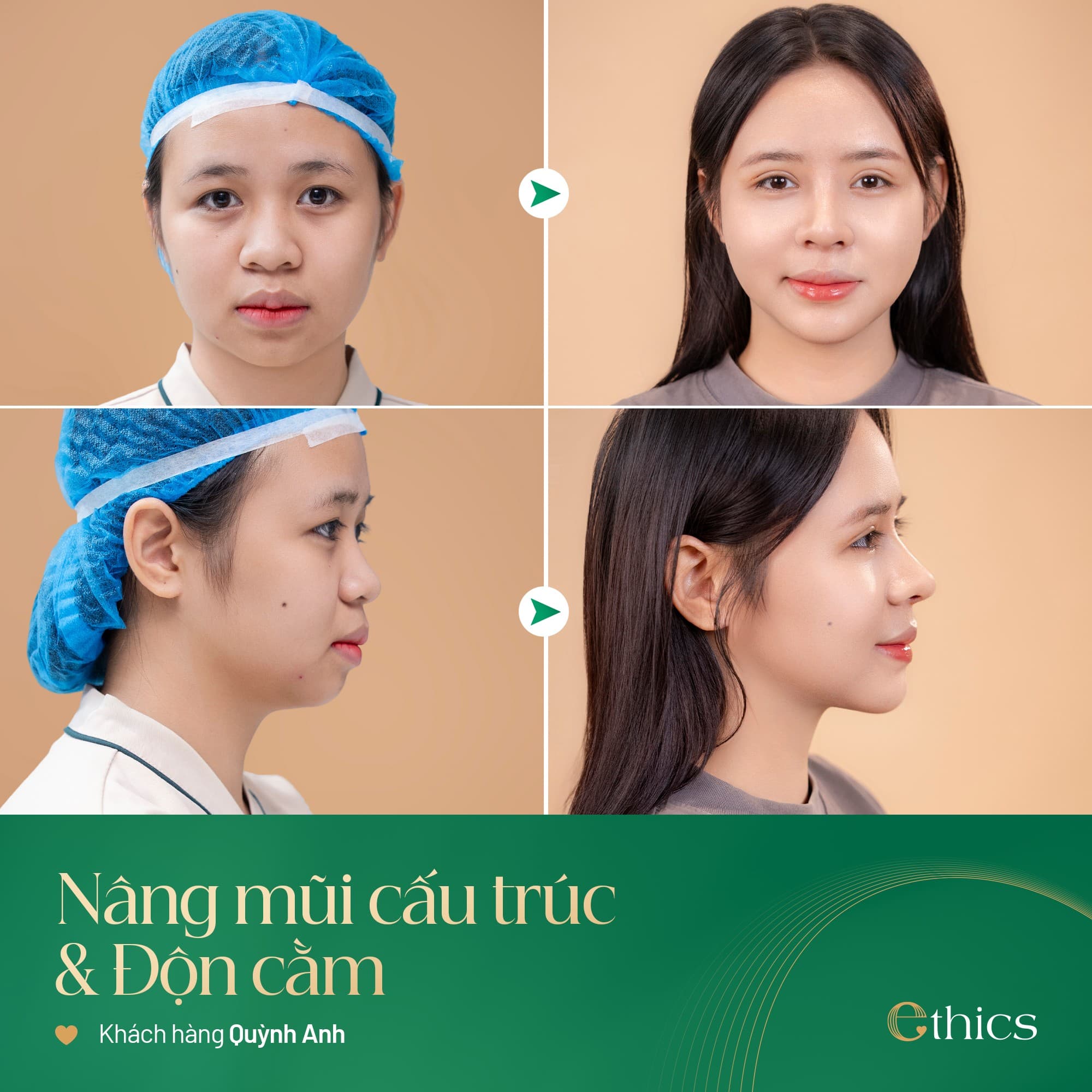 Ethics (Softxil) chin implant