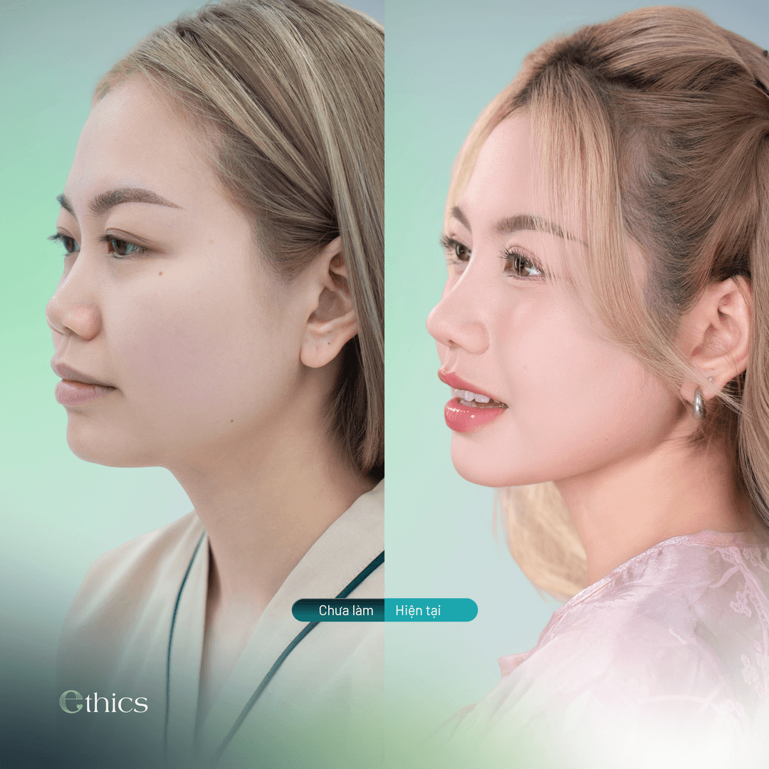 Here are before-and-after photos of a customer who underwent a rhinoplasty (nose augmentation)