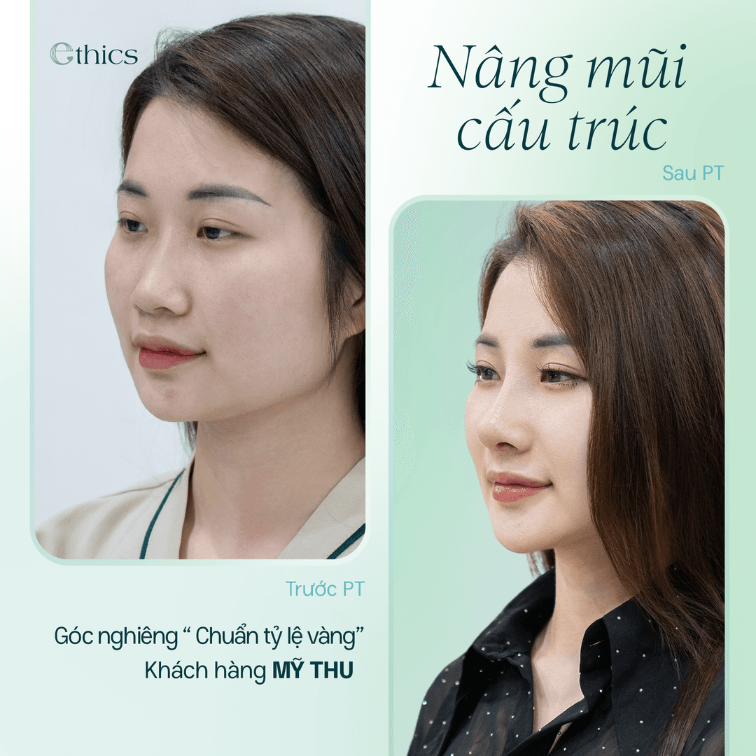 Structural Rhinoplasty - A New Look in Just 10 Days