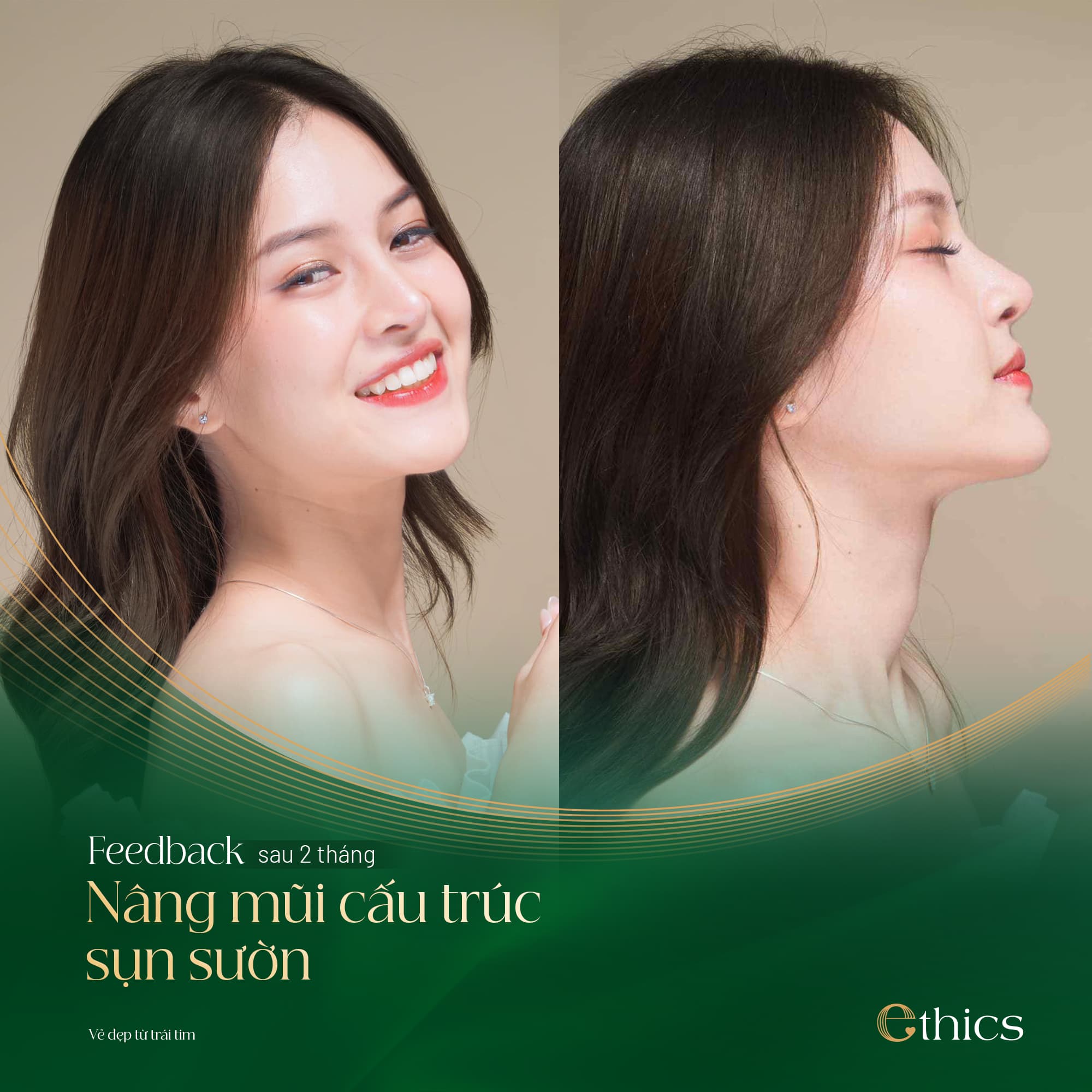 Rhinoplasty with Rib Cartilage Structure