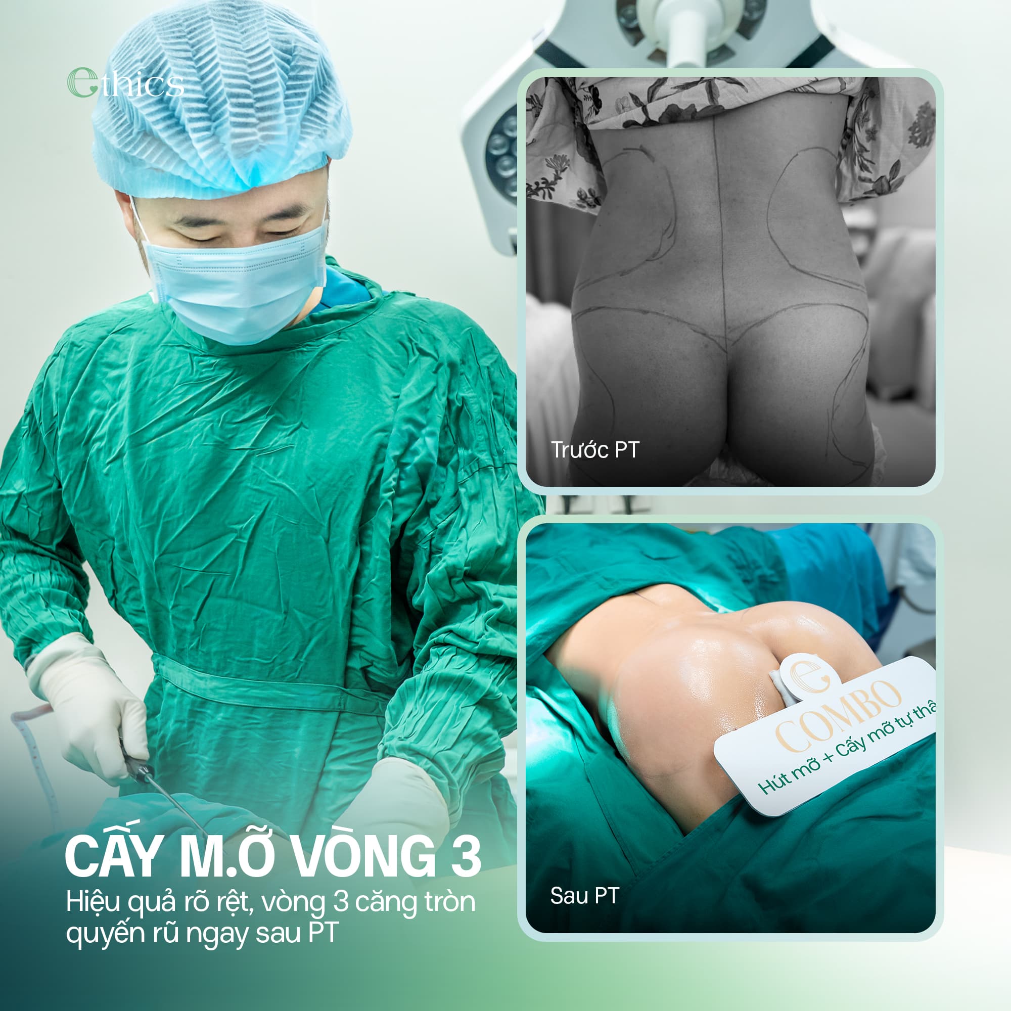 Full buttock augmentation
