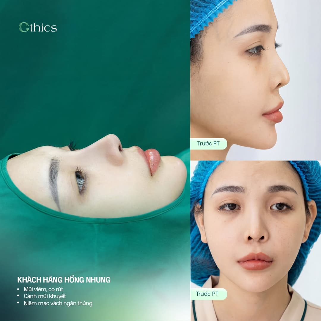 Image from an Ethics post: client Hong Nhung, labeled “Inflamed, contracted nose”, “Missing nostril wing” and “Perforated septal mucosa”, with two images labeled Before surgery