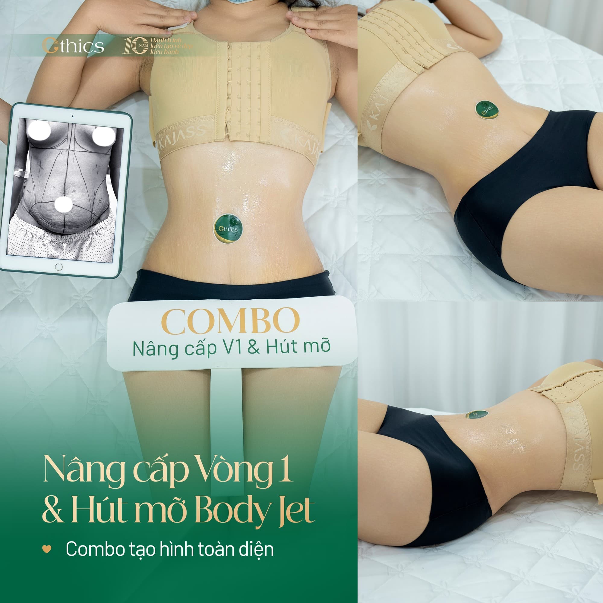 Breast augmentation (or breast fat transfer)
