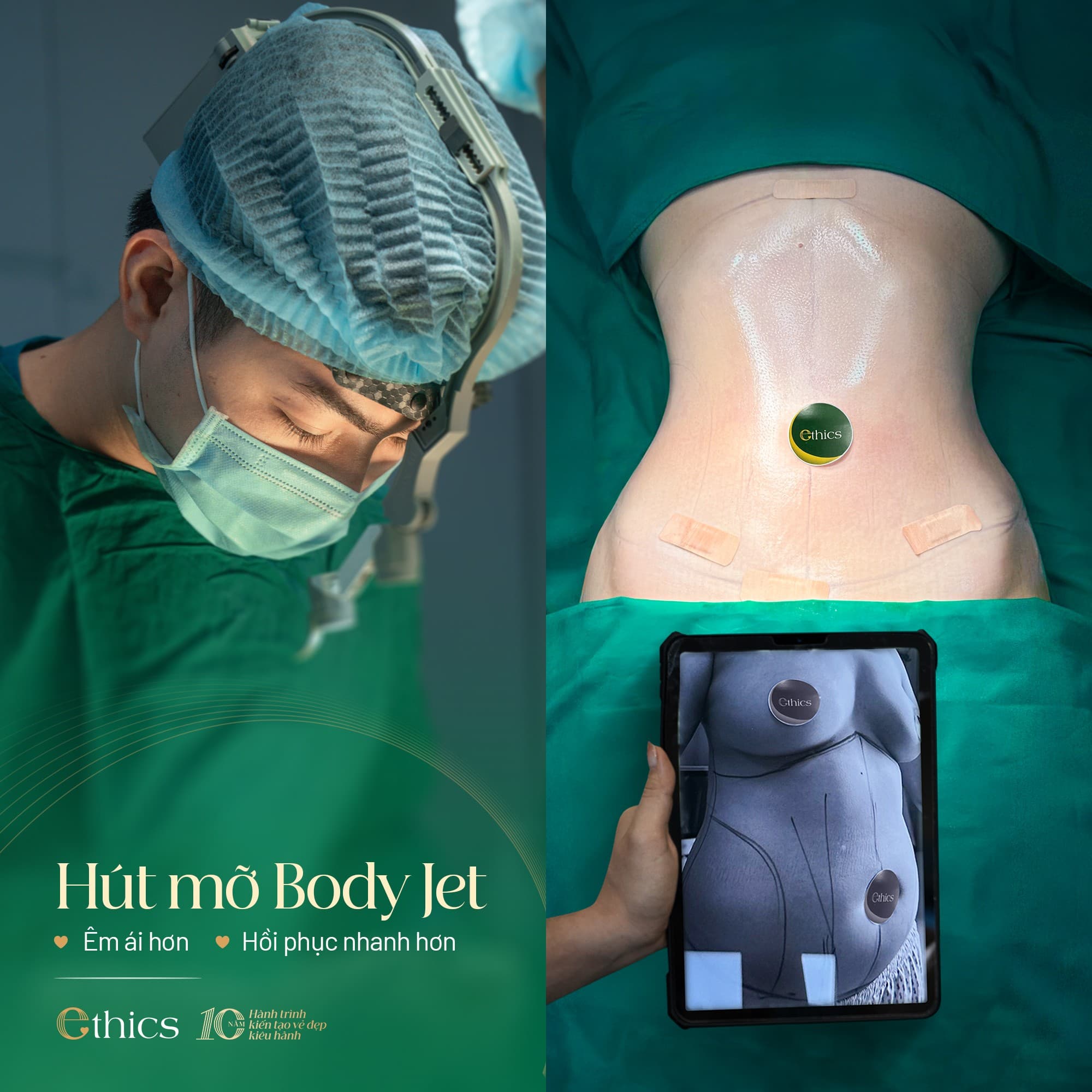 Underarm sweat gland excision/suction