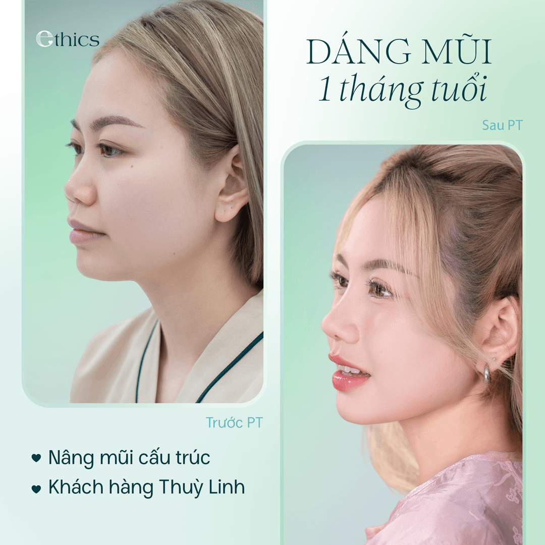 Before and after comparison image of the client's structural rhinoplasty