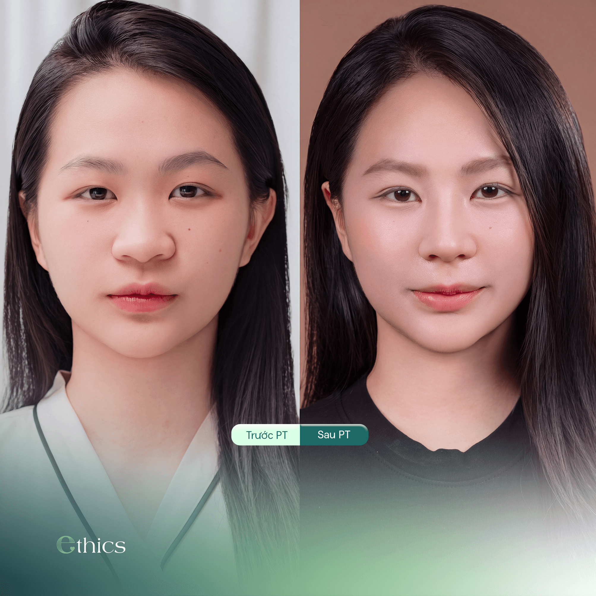 How Should the Rib Cartilage Harvest Site Be Cared for After Rhinoplasty?
