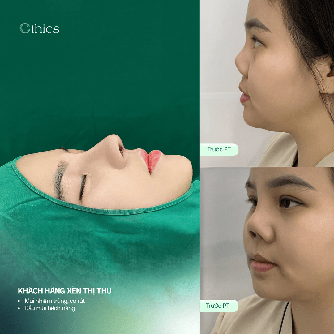 Before-structural-rhinoplasty comparison image of the patient