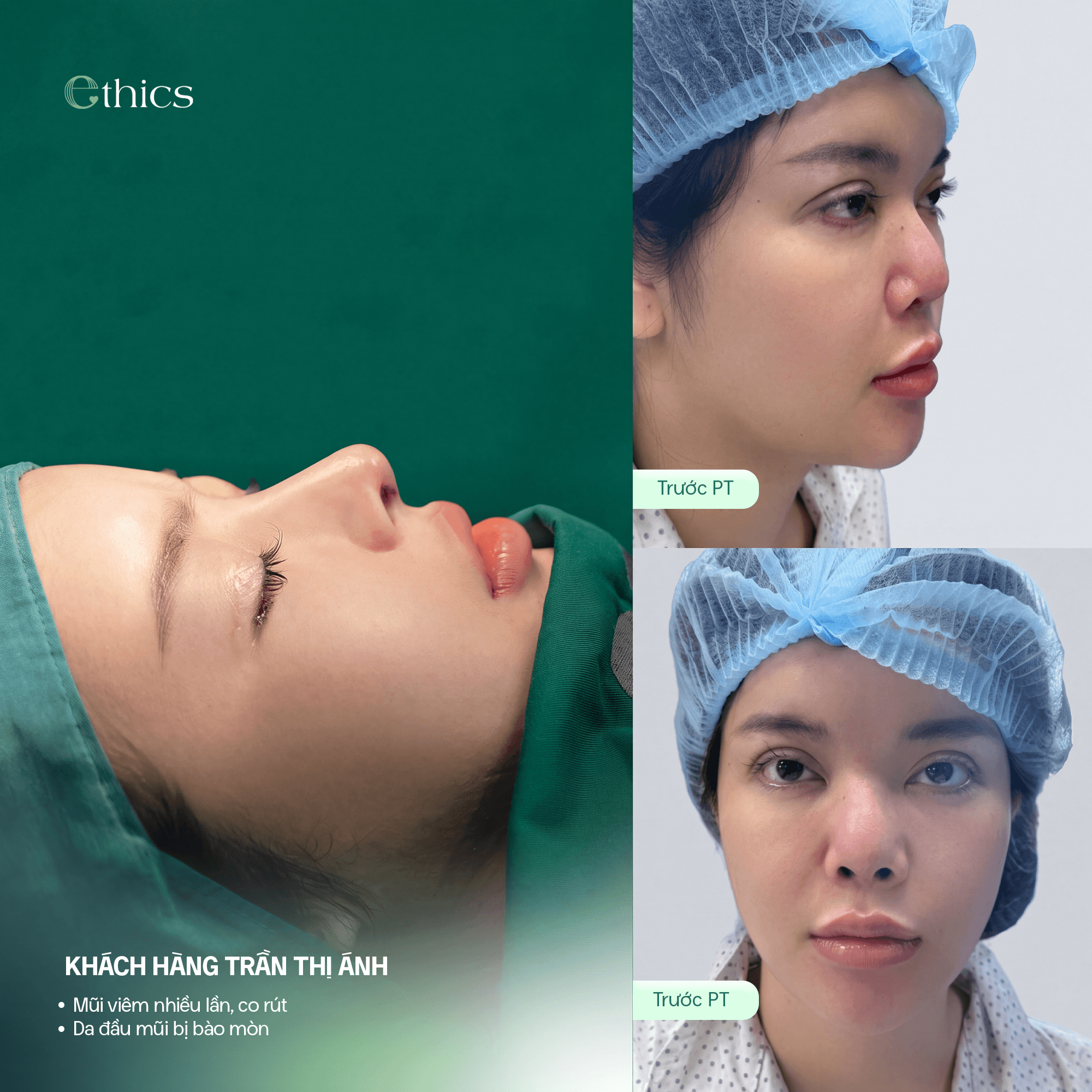 Rib Cartilage Structural Rhinoplasty: When Can You Resume Physical Activity?